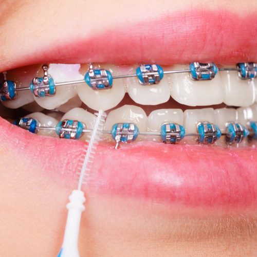 Aparelho Ortodôntico
